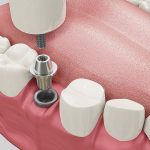 Ce implant dentar să alegeți: într-o etapă sau în două etape